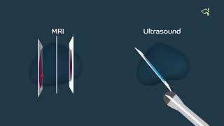 MRI/US fusion for targeted prostate biopsy