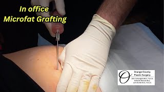 Microfat Grafting  | Orange County Plastic Surgery #