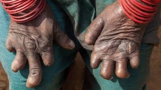 Leprosy (ලාදුරු) lecture part 06