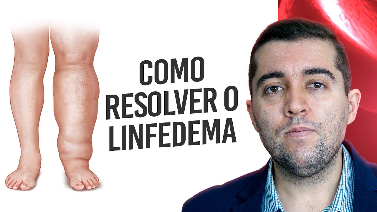 Linfedema: Má Circulação Nos Linfáticos Que Causa Inchaço E Dor Nas ...