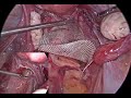 Laparoscopic Repair of 3rd Degree Prolapse of Nulliparous Uterus By Dr.Pragnesh Shah M.D.F.I.C.O.G.,