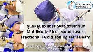 ดูแลหลุมสิว รอยดำ รอยแดงสิวด้วย MultiMode Picosecond Laser + Gold Toning Pico Laser  หมอรุจชวนคุย