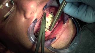 Jaw Fracture - Fixating Mandible and Maxilla