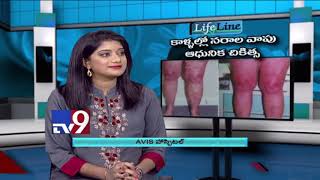 New Treatments for Varicose Veins - Dr. Rajah V Koppala | Avis Hospitals