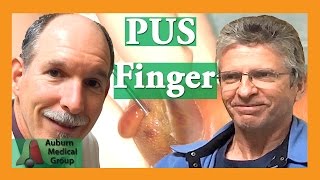 Finger Infection PUS popping | Auburn Medical Group