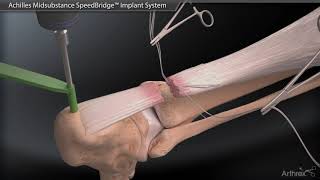 Achilles Midsubstance SpeedBridge™ Implant System