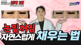 눈밑꺼짐 자연스럽게 채우는 법! - 쥬베룩 누적사용량 전국 1위 (~23년 9월현재) [피부과전문의 피부심]