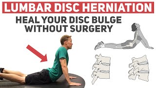 How to Heal Your Disc Herniation Without Surgery