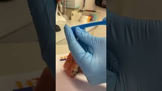 Lost the hole in the palate expander? No problem. @ParkViewPedDent