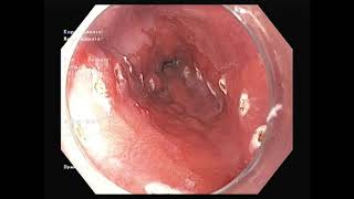 Barets Esophagus. Cancer. ESD with traction method