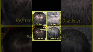 티나지않는 두피문신은 오직 브루스엠 #두피문신 #특허기술 #hairloss #scalpmicropigmentation #shorts