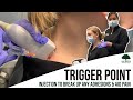 Trigger Point Injection to Break Up Any Adhesions & Aid Pain Relief