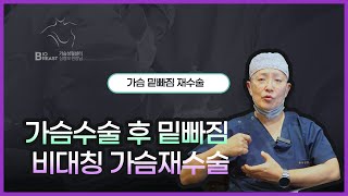 가슴수술 후 밑빠짐 비대칭 가슴재수술 [BIO 가슴성형 - 심형보 원장]