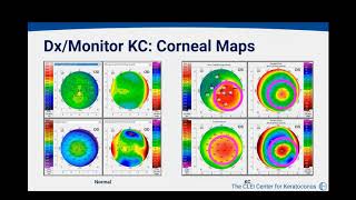 Corneal Collagen Crosslinking for Keratoconus 2/21/2020