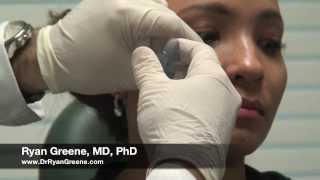 Juvederm VOLUMA Liquid Cheek Lift in Weston Florida - Dr. Ryan Greene