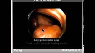 Chicago Live Course 2013 - Difficult  Polypectomy