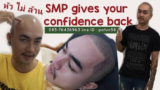 SMP สักปกปิดศีรษะล้าน กับ ผงโรย