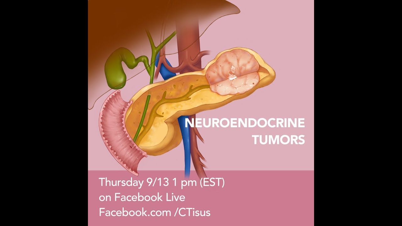 Facebook Live: Pancreatic Neuroendocrine Tumors - YouTube