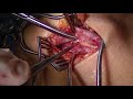 Cephalic Arch Reconstruction (Eric K. Peden, MD, M. Mujeeb Zubair, MD)