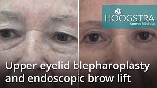 Upper eyelid blepharoplasty and endoscopic brow lift (20087)