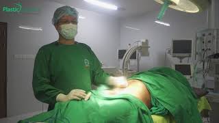 Penis Enlargement Surgery | লিঙ্গ বড় করার সার্জারি | penile lengthening surgery