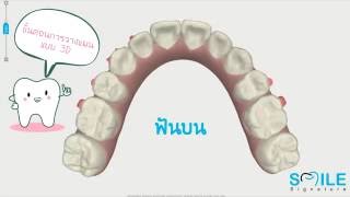 จัดฟันแบบใส Invisalign ตอน 2