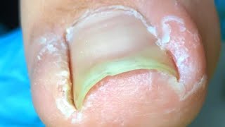 Sharp Ingrown Toenail Hurts Toe, Pedicure Treatment【Crazy pedicure room】