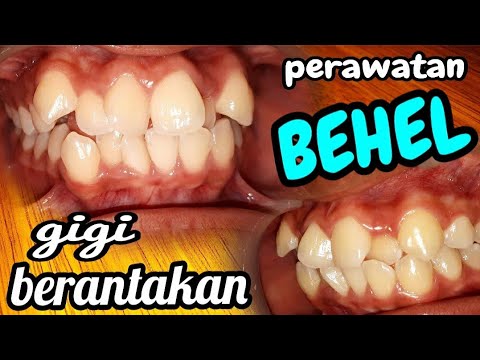 8 Bulan Behel Gigi Berantakan, Cara Merawat Behel Dengan Benar, Dokter ...