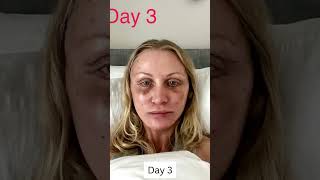 3 Month Facelift Healing and Recovery Process!