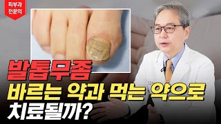 발톱무좀 먹는 약 or 바르는 약으로 얼마나 치료될까? 🦶🏻