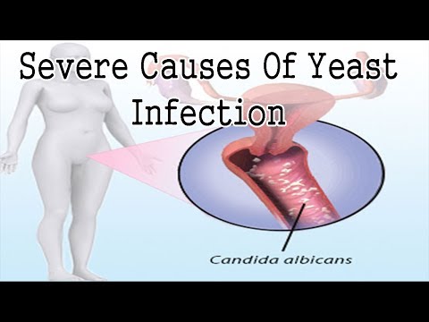 What Causes Vaginal Yeast Infection ? Severe Causes Of Yeast Infection In Woman What Causes Vaginal Yeast Infection ? Severe Causes Of Yeast Infection In Woman
