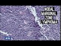 Nodal Marginal Zone Lymphoma