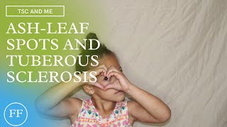 TSC And Me | Ash Leaf Spots and Seizures as a Toddler