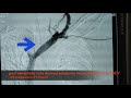 central venous stenosis treatment medanta hospital lucknow venoplasty