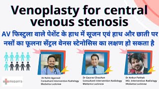 Central venous stenosis treatment, Medanta hospital Lucknow # Venoplasty