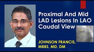 Proximal And Mid LAD Lesions In LAO Caudal View