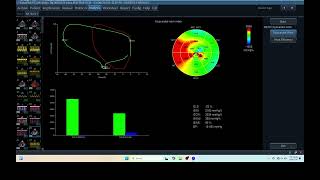 IQ 223 ECHOCARDIOGRAPHY ECHOPAC ANALYSIS GWE MYOCARDIAL WORK EFFICIENCY INDEX  MEASUREMENT