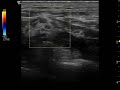 arteries cross c5 during interscalene nerve block