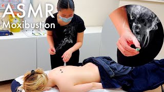 ASMR moxibustion and full body accupuncture (Unintentional, real person asmr) [Chinese Medicine]