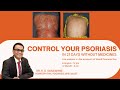 How to control your Psoriasis : Live Webinar in Marathi