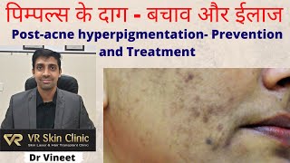 पिम्पल्स के दाग से पाएं छुटकारा -Get rid of post acne hyperpigmentation | VR Skin Clinic | Dr Vineet