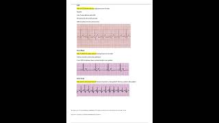 Relias Dysrhythmia Basic B Test 35 Questions and Answers 2023