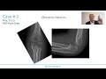 use of bioresorbable implants in pediatric traumatology prof. pierre lascombes specialist webinar