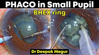 Phaco in an eye with Small pupil, Pseudoexfoliation, and weak zonules:- BHEX device -Dr Deepak Megur