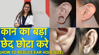 कान का छेद हमेशा के लिए छोटा करने का आसान तरीका | ear hole repair | #Earlobe