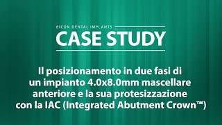 Il posizionamento in due fasi di un impianto 4.0x8.0mm mascellare anteriore