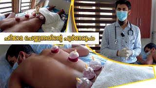 Hijama Cupping Therapy ചെയുന്നത് കണ്ടാലോ | Hijama Treatment Malayalam | Hijama Video | Hijama