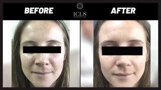 How to Remove PIGMENTATION (Melasma) | Skincare | ICLS Dermatology \u0026 Plastic Surgery