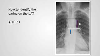 04. How to confidently identify the carina