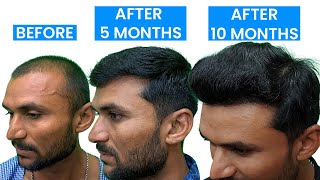 Hair Transplant Result After 10 Months | Best Hair Transplant In Nashik |